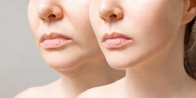 Flacidez e contorno facial: quais cuidados podem ser avaliados?